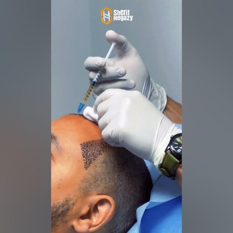 زراعة الشعر
