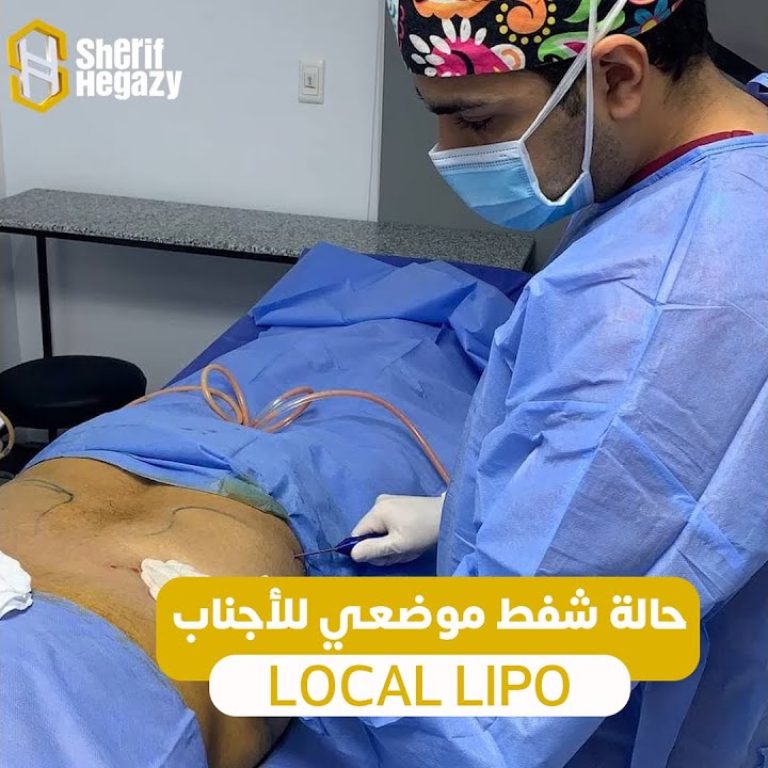 شفط موضعي للأجناب -30 دقيقة فقط