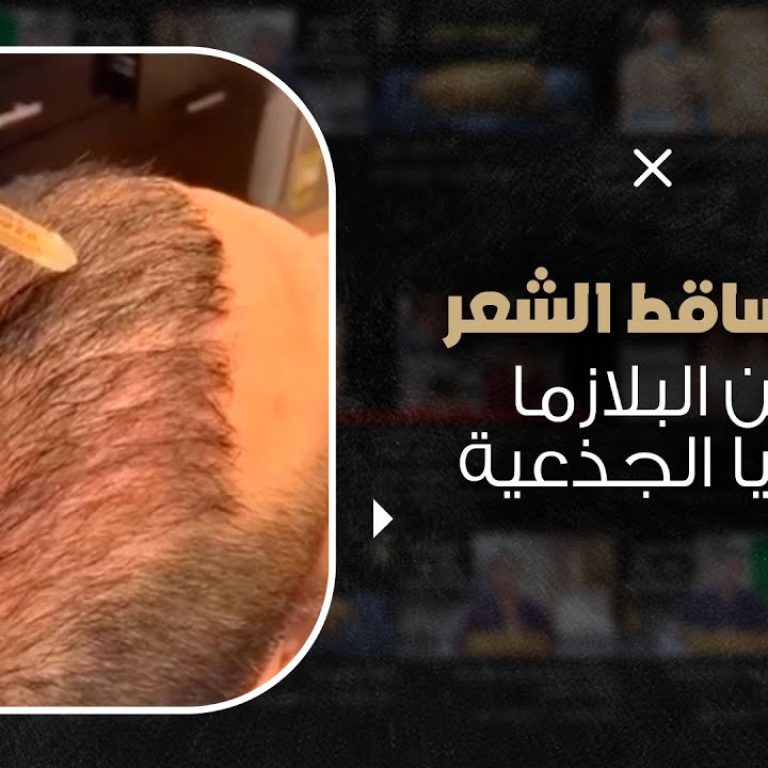 علاج تساقط الشعر بحقن البلازما والخلايا الجذعية