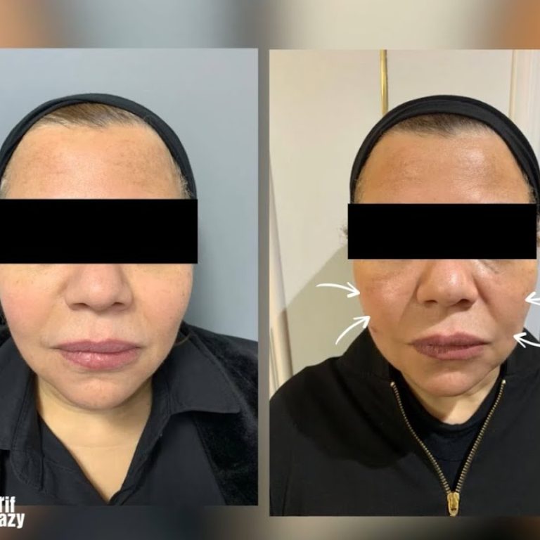 نهاية تجاعيد الوجه من أول جلسة - بدون جراحة