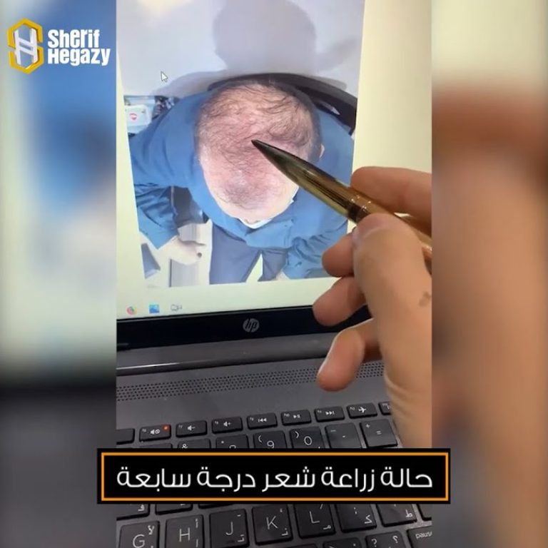 نتيجة غير متوقعة لزراعة الصلع من الدرجة السابعة