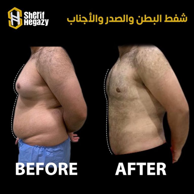 نتيجة مميزة لشفط الدهون بالفيزر