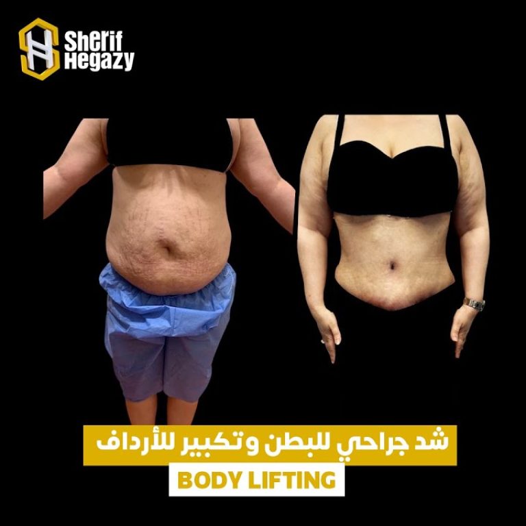 نتيجة اصلاح الولادات المتكررة عن طريق الشد الجراحي للبطن