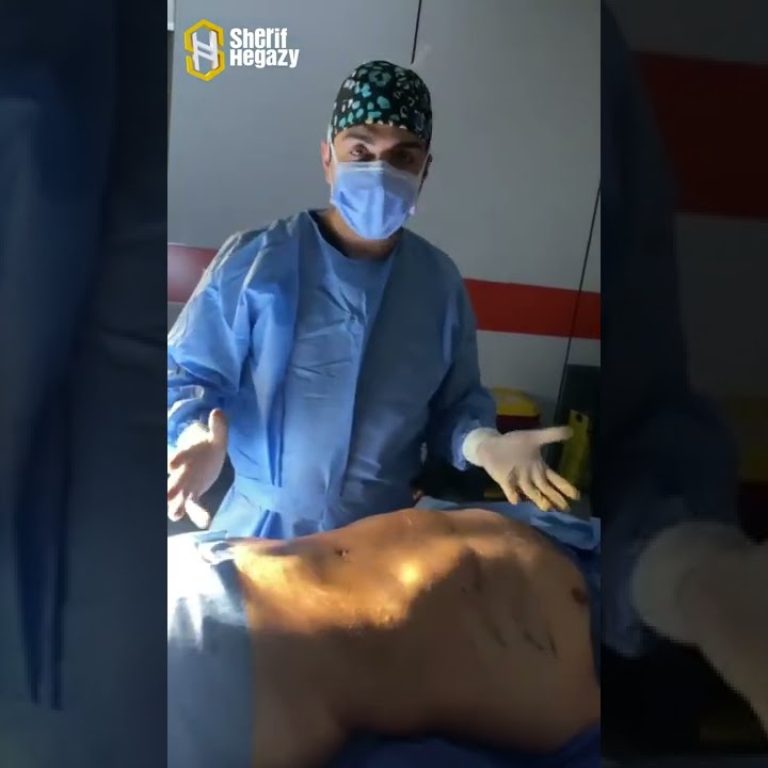 شاهد نتيجة التخلص من دهون البطن والاجناب الموضعي بنحت عالي التحديد