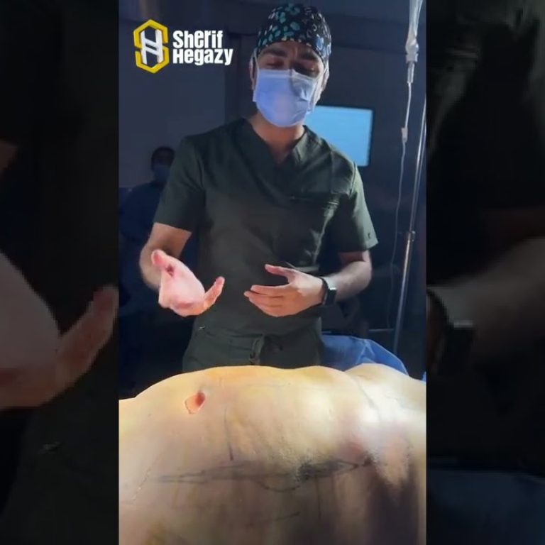 شاهد نتيجة نحت الدهون بالفيزر من داخل غرفة العمليات