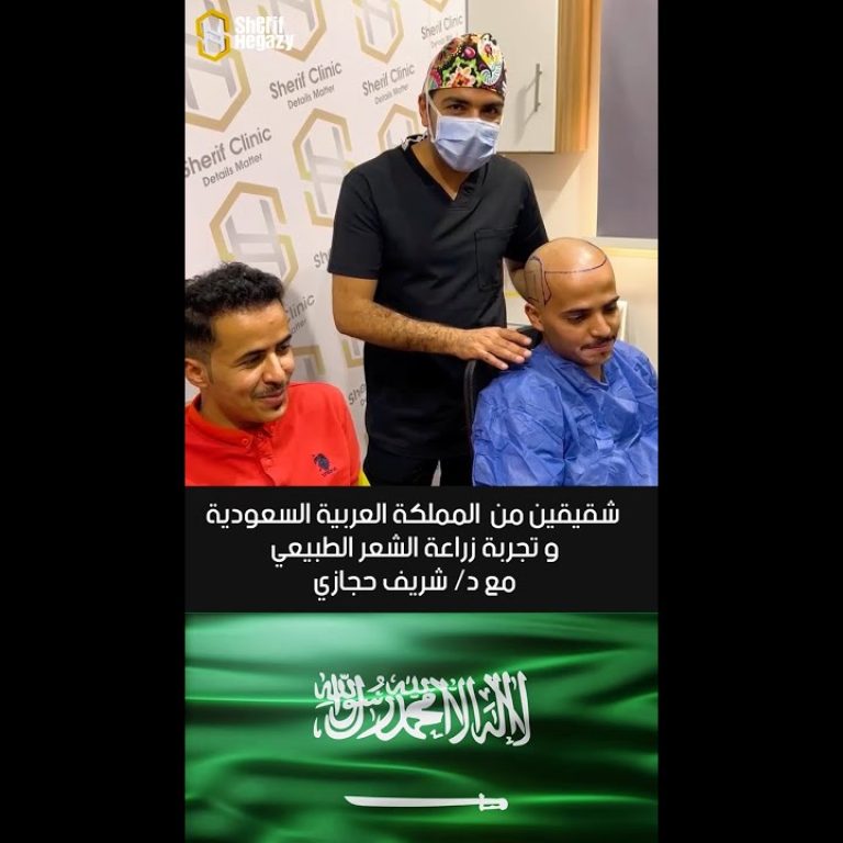 شاهد نتيجة رائعة لزراعة الشعر الطبيعي لأخواتنا من السعودية