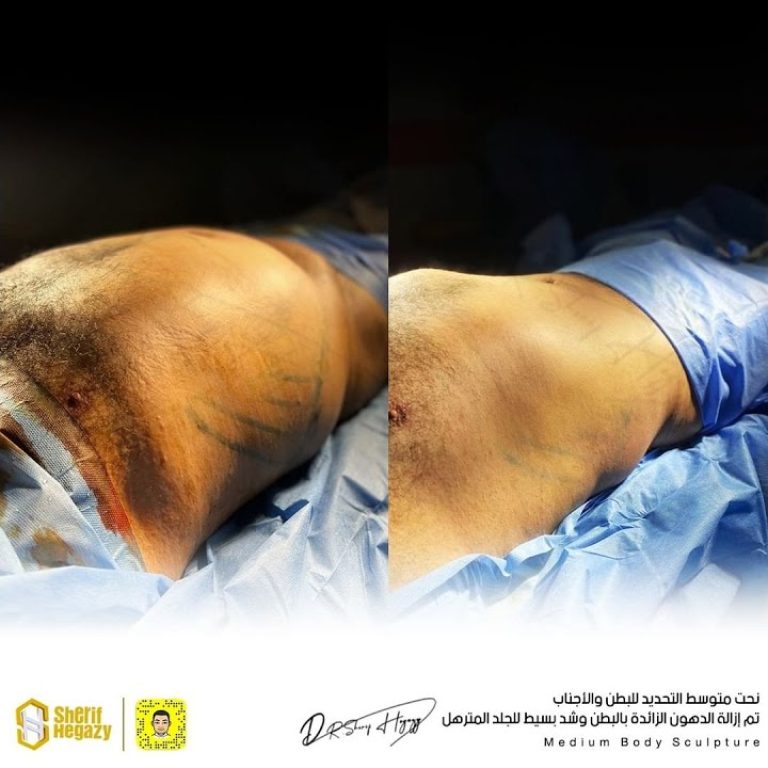 أيه الفرق بين نحت الجسم عالي التحديد ومتوسط التحديد ؟