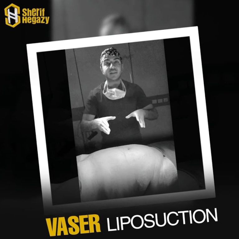 نتيجة مميزة لشفط دهون وشد البطن الجراحي بإستخدام تقنية الفيزر