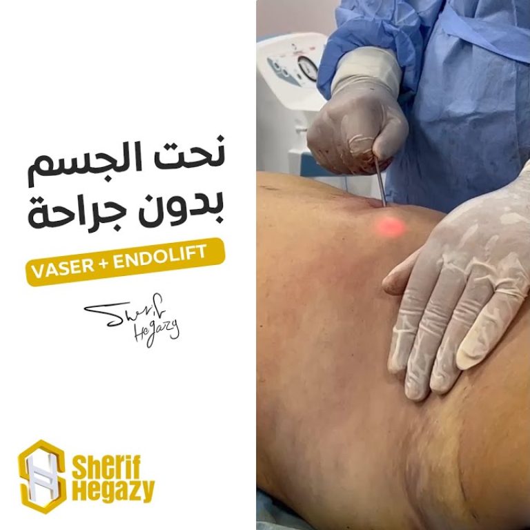 شاهد نحت مثالي للجسم بدون جراحة بإستخدام جهازي الفيزر والأندولفت