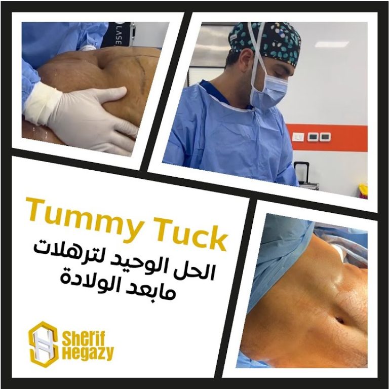 شاهد نتيجة شد البطن للتخلص من ترهلات ما بعد الولادة