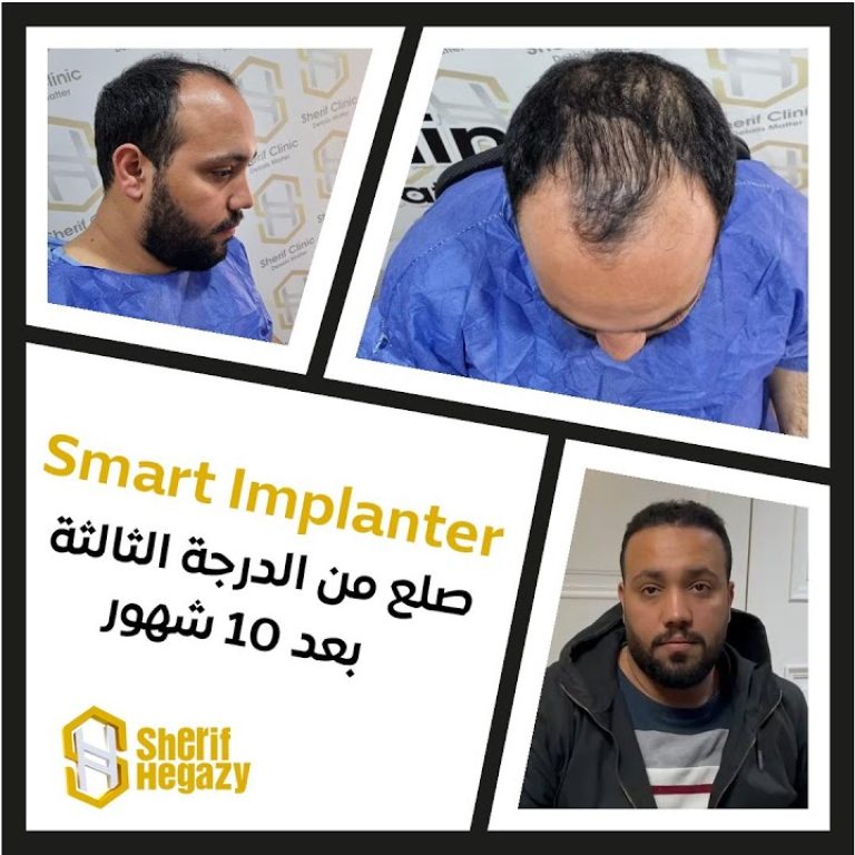 نتيجة مذهلة للتخلص من الصلع من الدرجة الثالثة