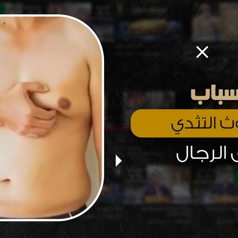 أسباب حدوث التثدي لدى الرجال