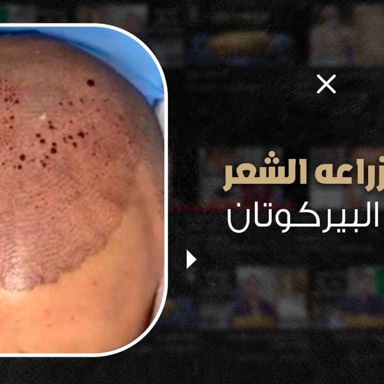 زراعة الشعر في أقل وقت ممكن بأحدث تقنيات زراعة الشعر في العالم