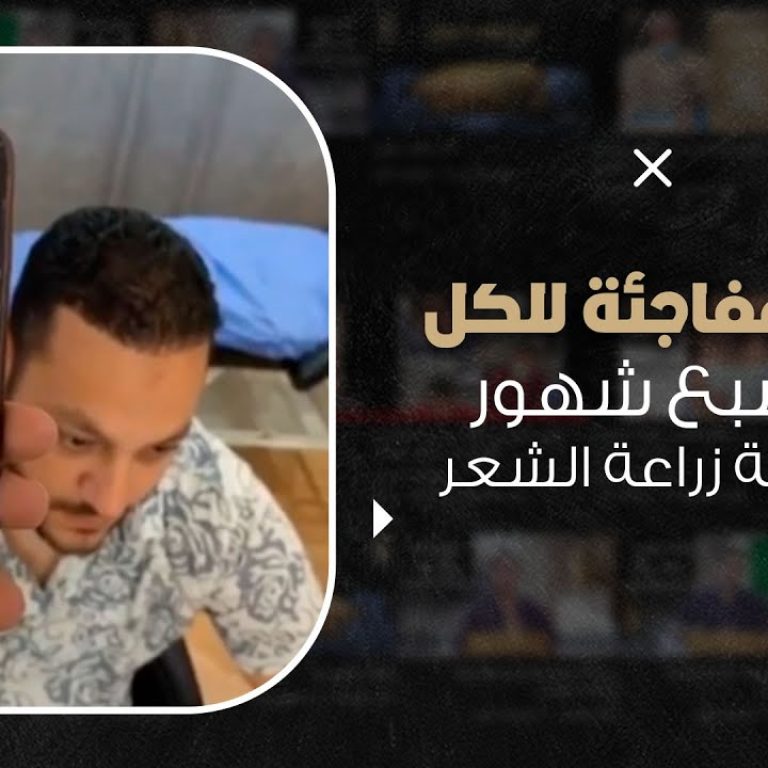شاهد نتيجة لأحد الحالات بعد زراعة الشعر بسبع شهور