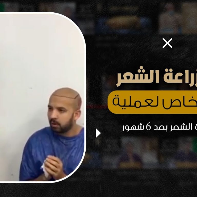 تجربة زراعة الشعر وتقييم خاص لعملية تصحيح زراعة الشعر بعد 6 شهور