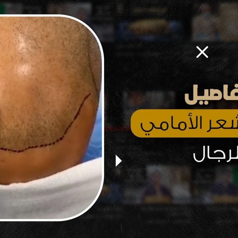 تفاصيل زراعة الشعر الأمامي للرجال