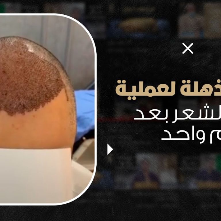 نتيجة مذهلة لعملية زراعة الشعر بعد يوم واحد