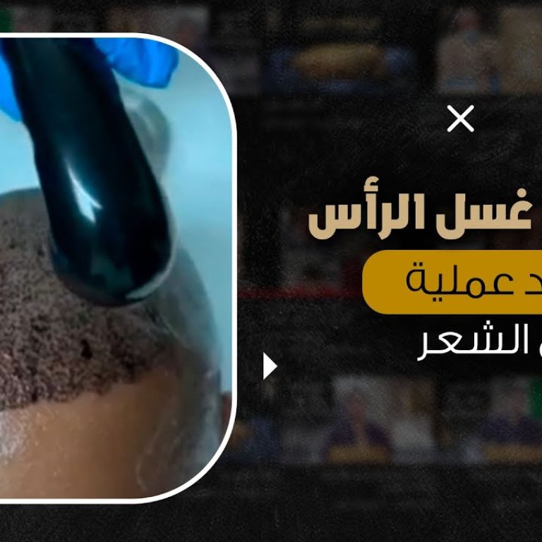 كيفية غسل الرأس بعد عملية زرع الشعر