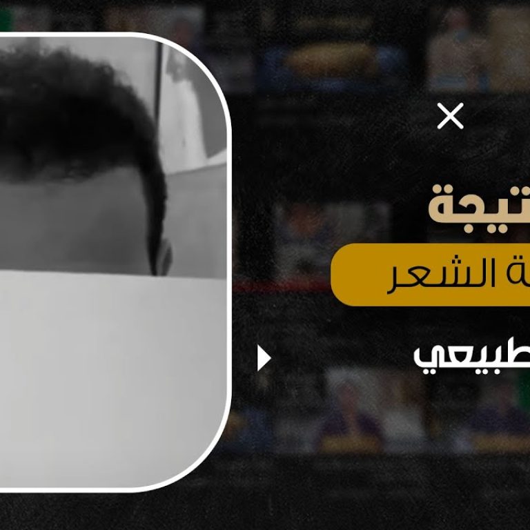 نتيجة زراعة الشعر الطبيعي بعد 6 شهور