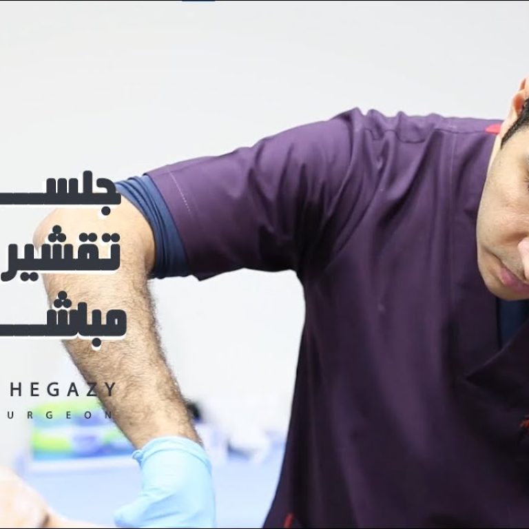 جلسة تقشير مباشرة