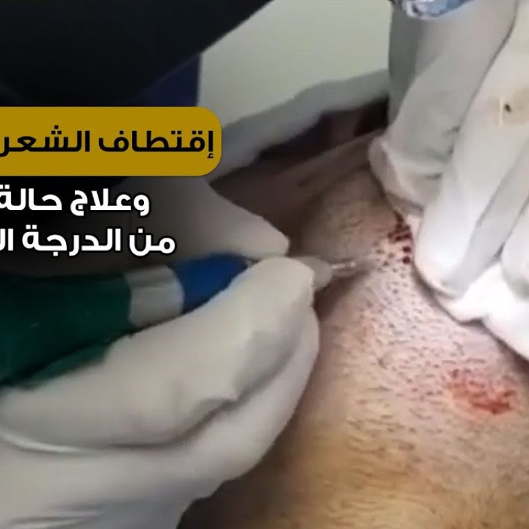 إقتطاف الشعر من الذقن وعلاج حالة صلع من الدرجة السابعة