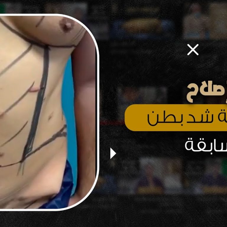 طريقة شفط الدهون بدون ألم