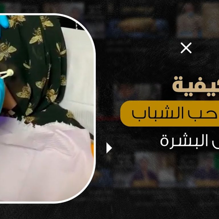 كيفية علاج آثار حب الشباب