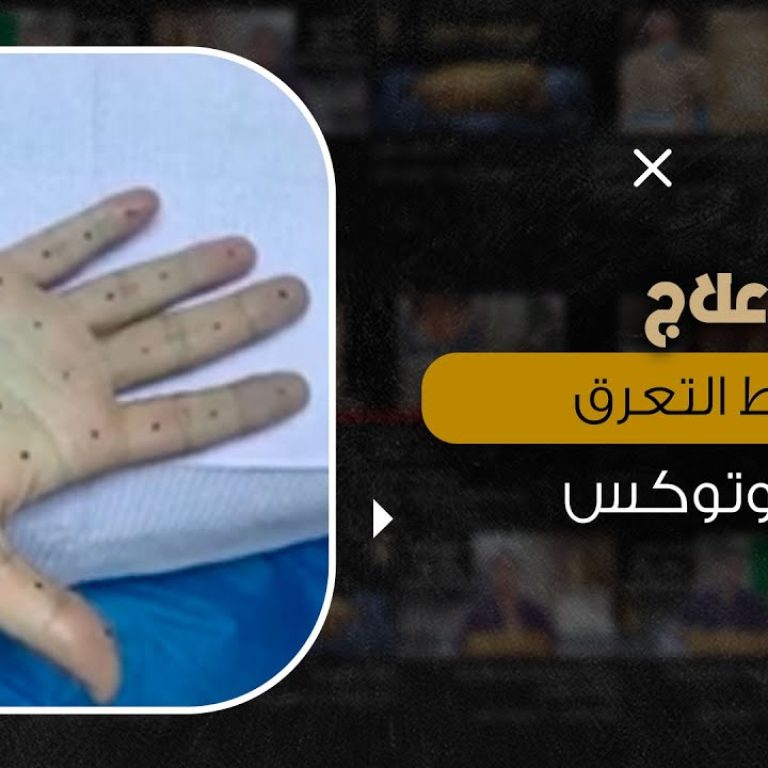 علاج فرط التعرق بالبوتوكس