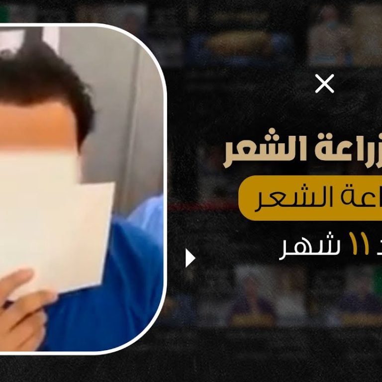 نتيجة زراعة الشعر الطبيعي لحالة صلع من الدرجة الخامسة بعد 11 شهر