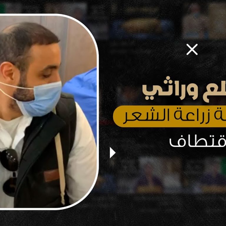 علاج الصلع الوراثي بزراعة شعر طبيعي 100% شاهد النتيجة مباشرة من داخل العمليات