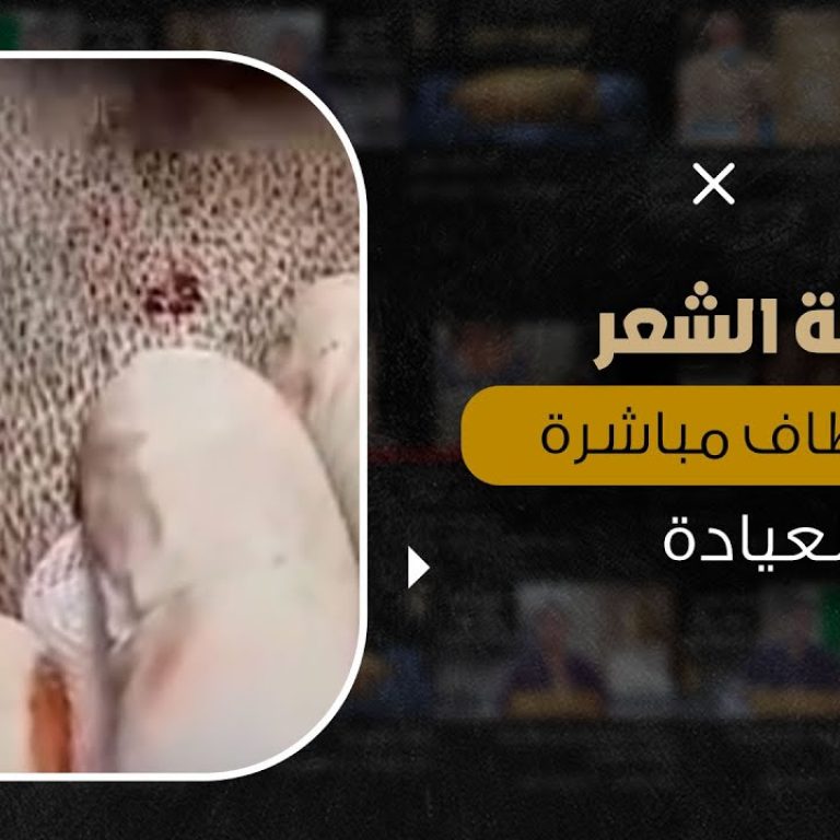 زراعة الشعر بالاقتطاف في عياداتنا