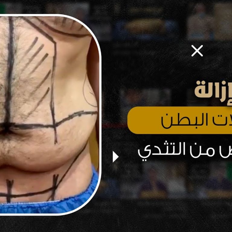 عملية شفط دهون البطن شاهد النتيجة مباشرة من داخل العمليات