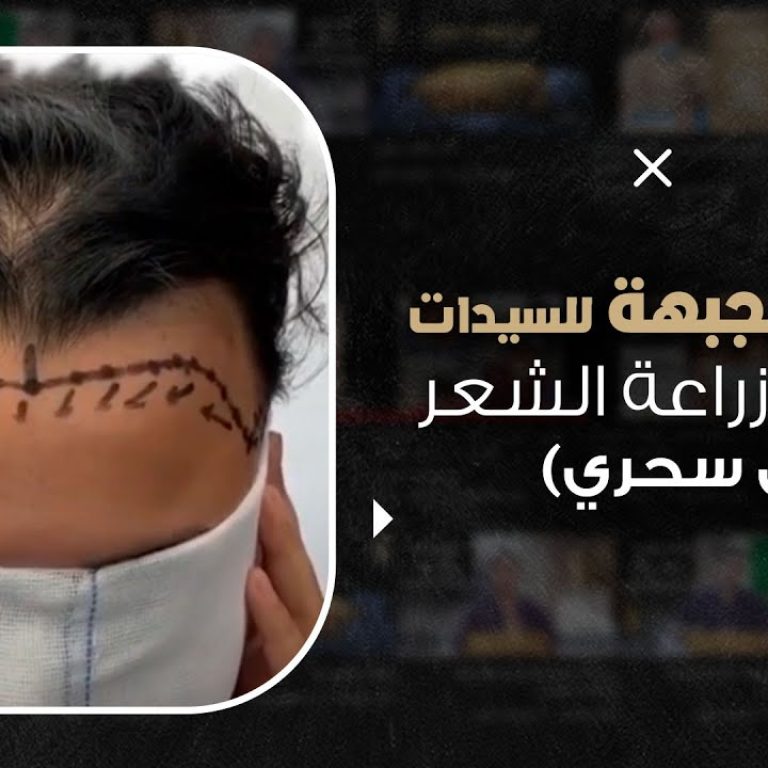 تصغير الجبهة للسيدات عن طريق زراعة الشعر (حل سحري)