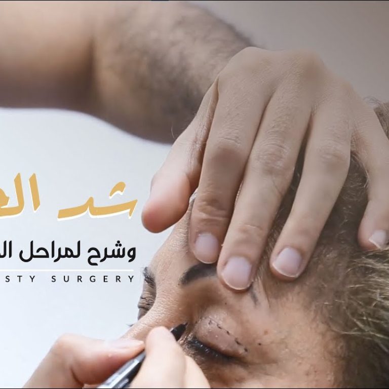 شد الجفون وشرح لمراحل العميلة بالتفصيل