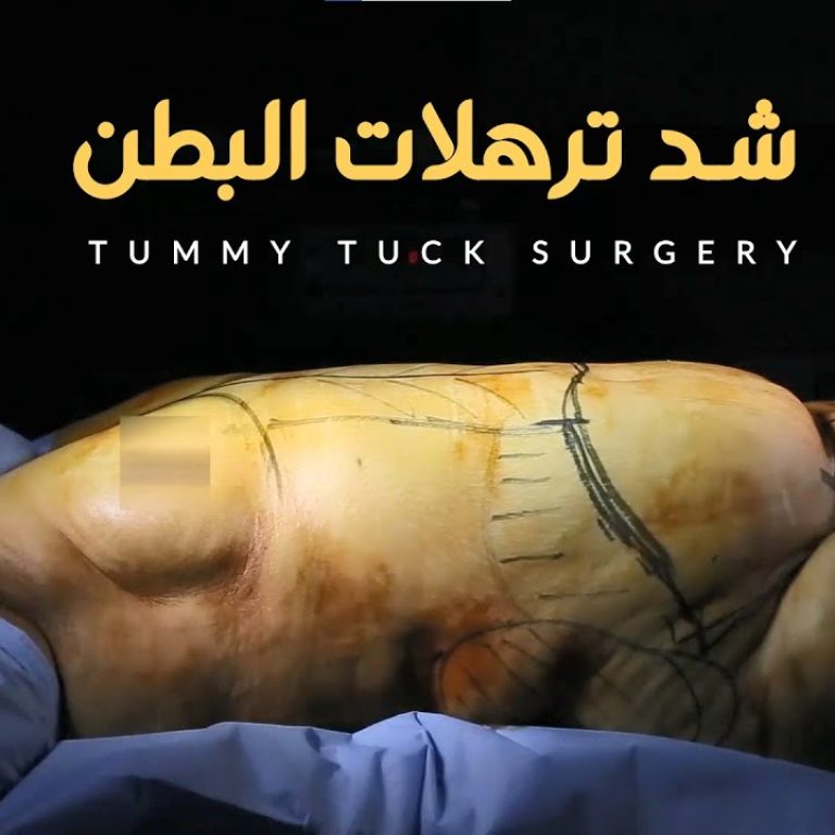 أعرف كل المعلومات عن شد ترهلات البطن