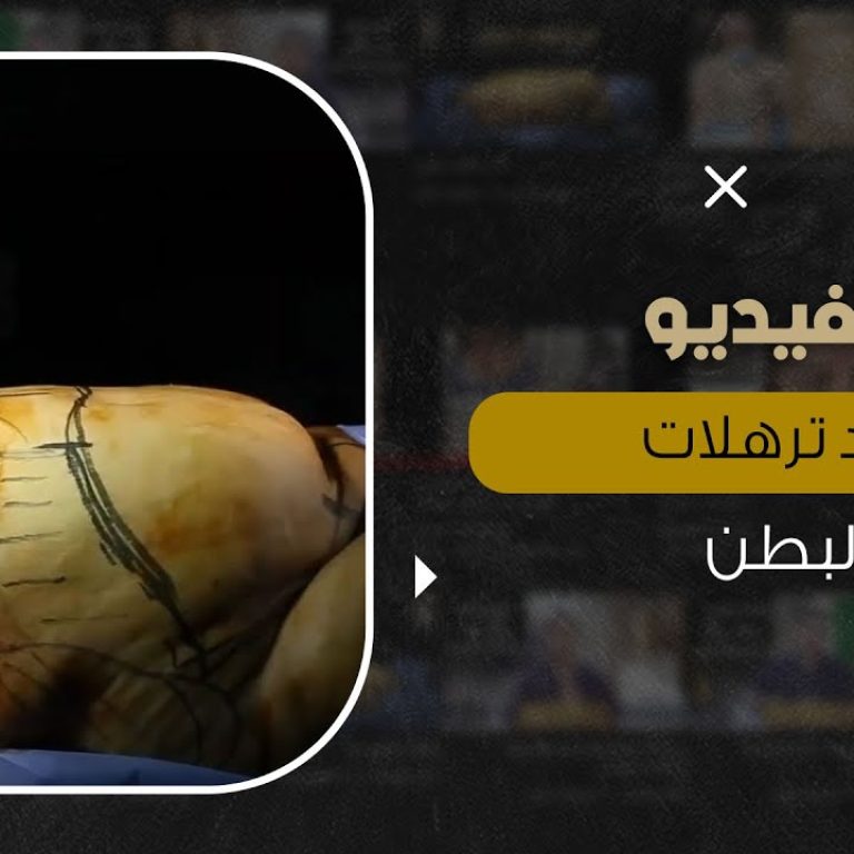 التخلص من ترهلات البطن بدون مجهود وبدون ألم