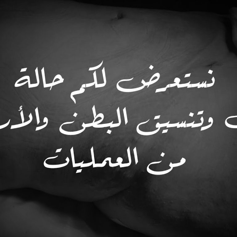 من داخل العمليات وشرح لخطوات عملية شد البطن