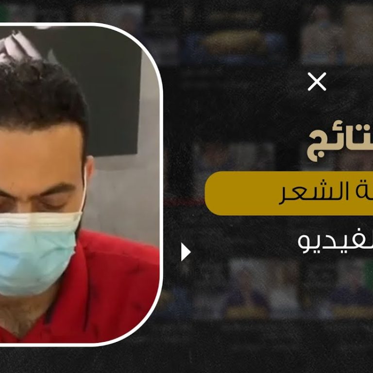 نتائج زراعة الشعر بالفيديو