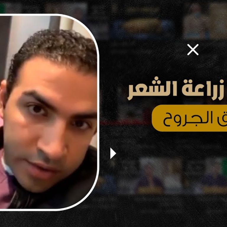 حقيقة زراعة الشعر فوق الجروح و الحروق