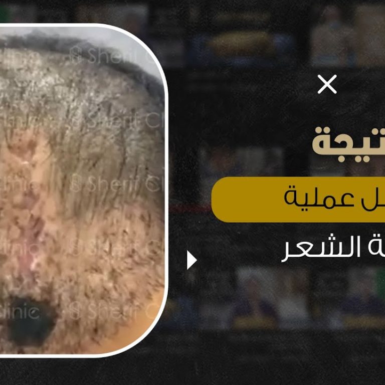 اصلاح عملية زراعة شعر فاشلة مباشرة