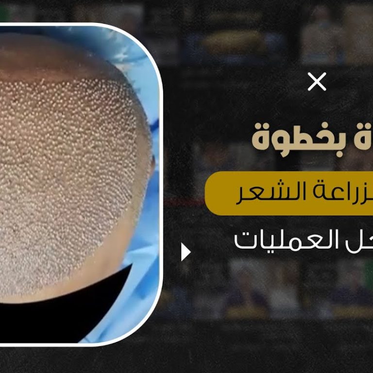 خطوة بخطوة عملية زراعة الشعر الطبيعي