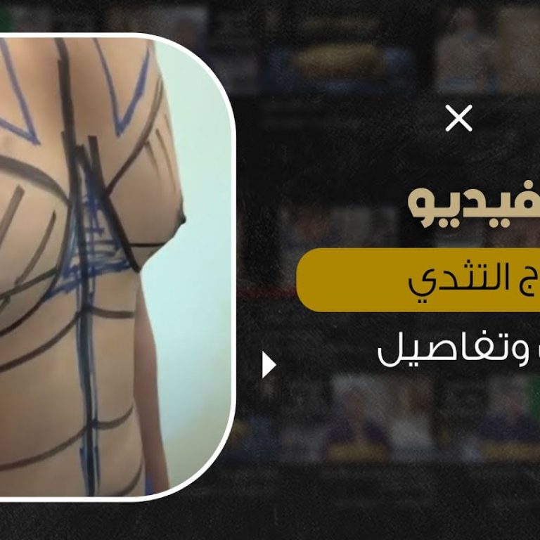 تفاصيل طرق علاج التثدي