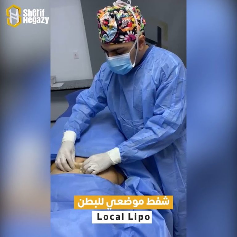 جلسة شفط موضعي للدهون بالتخدير الموضعي