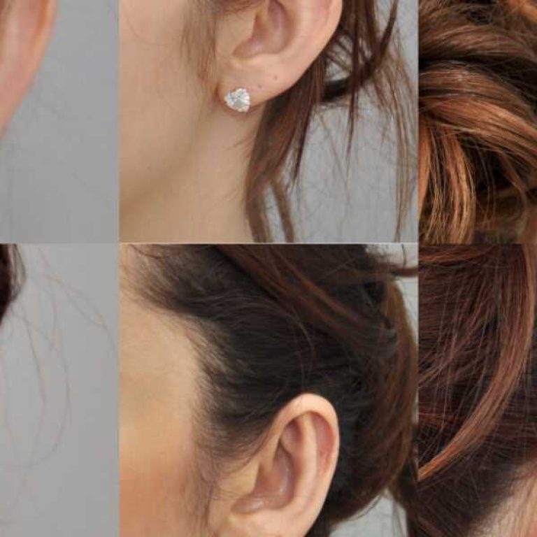 otoplasty