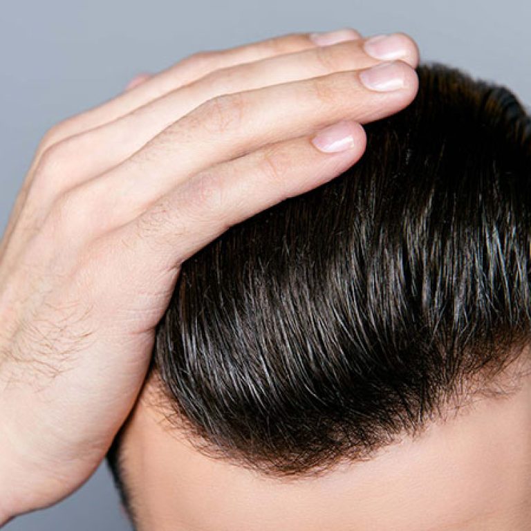 volden بديل زراعة الشعر
