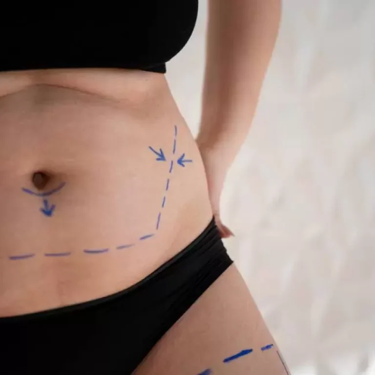 شفط دهون أسفل البطن