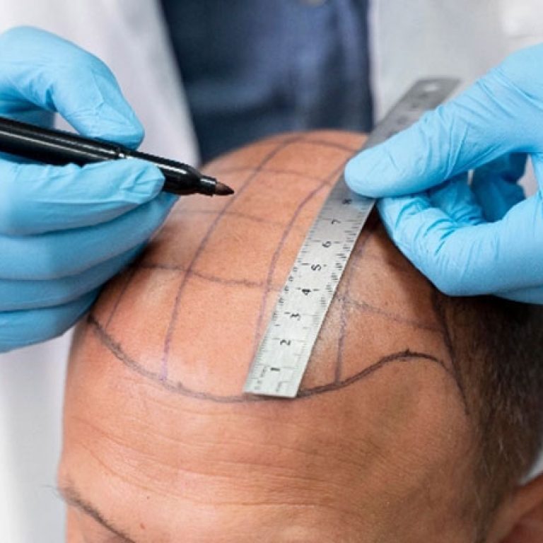 أرخص مراكز زراعة الشعر في مصر