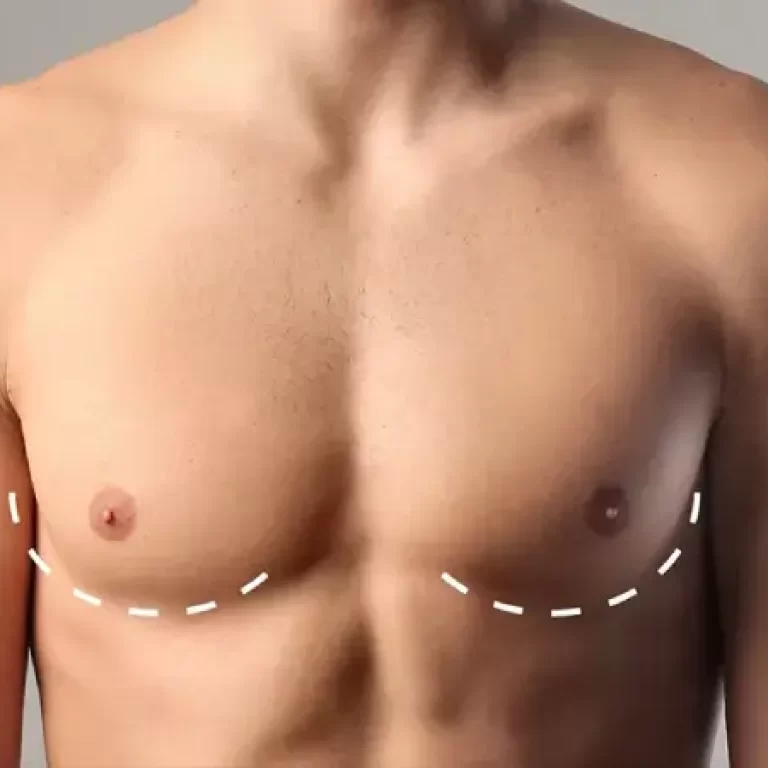 أسباب التثدي عند الرجال وعلاجه