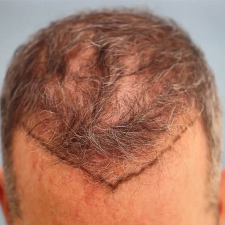 أسباب فشل زراعة الشعر