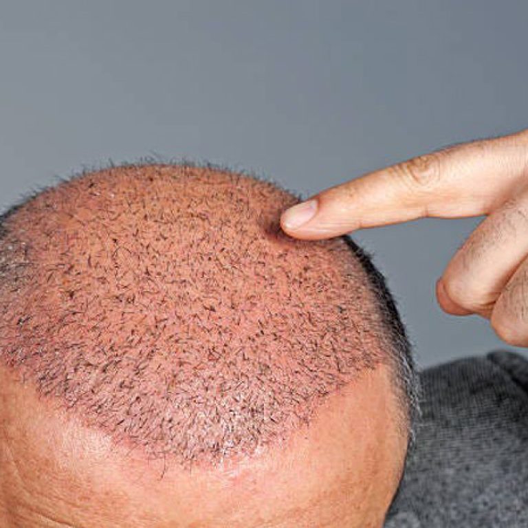 أضرار زراعة الشعر على المدى البعيد